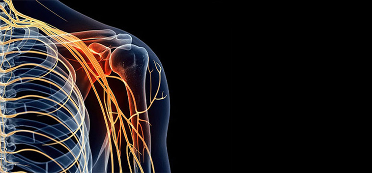 patient experiencing Brachial Plexus Neuropathy and in need of the neuropathy treatment protocol at Smith Family Chiropractic Wellness Center in Campbell