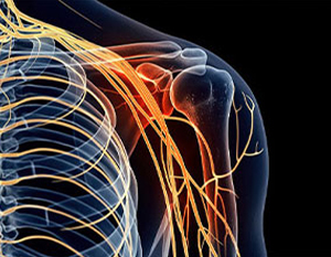brachial Plexus Neuropathy & Nerves