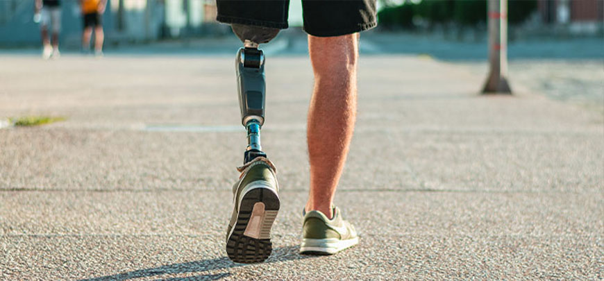 patient experiencing Phantom Limb Syndrome and in need of the neuropathy treatment protocol at Smith Family Chiropractic Wellness Center in Campbell