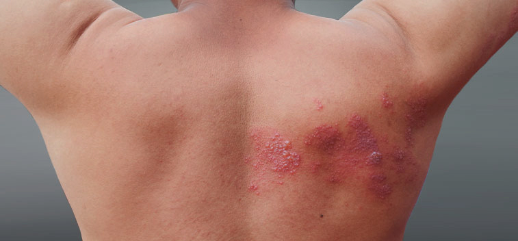 patient experiencing Post-Herpetic Neuralgia and in need of the neuropathy treatment protocol at Smith Family Chiropractic Wellness Center in Campbell